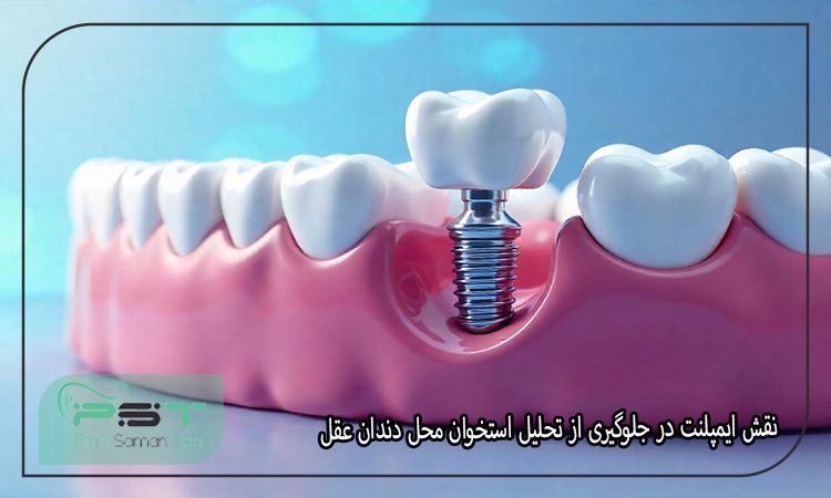 ایمپلنت دندان عقل