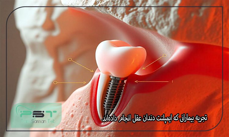 ایمپلنت دندان عقل