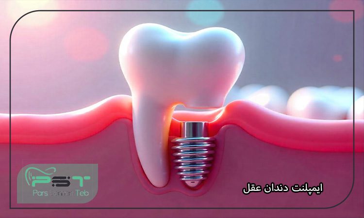 ایمپلنت دندان عقل