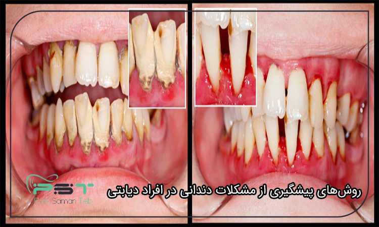 افراد دیابتی و تاثیر آن بر سلامت دندان