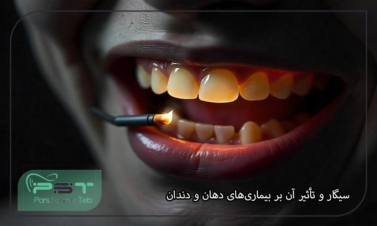 بیماریهای دهان و دندان ناشی از سیگار کشیدن