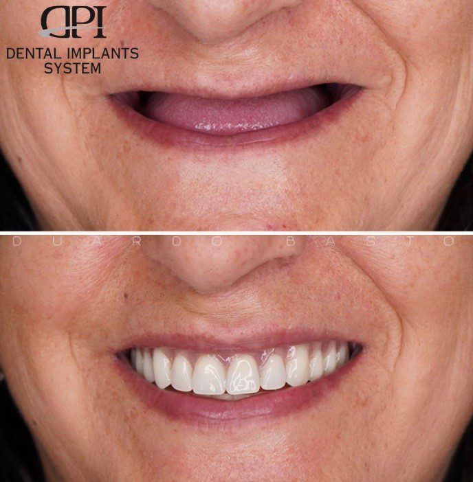 ایمپلنت دندانی برای بیماران قلبی