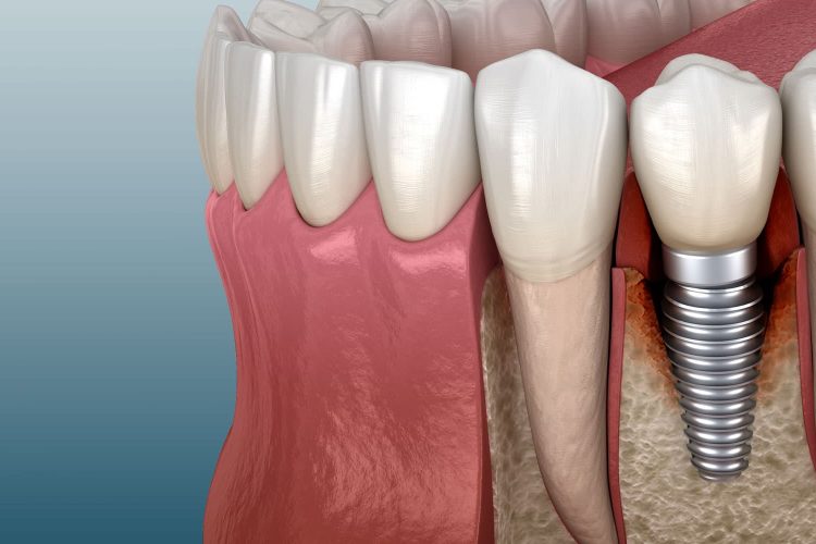Factors of dental implant failure