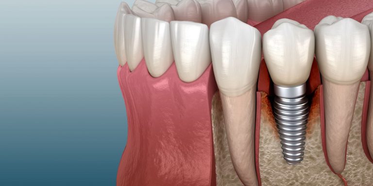 Factors of dental implant failure