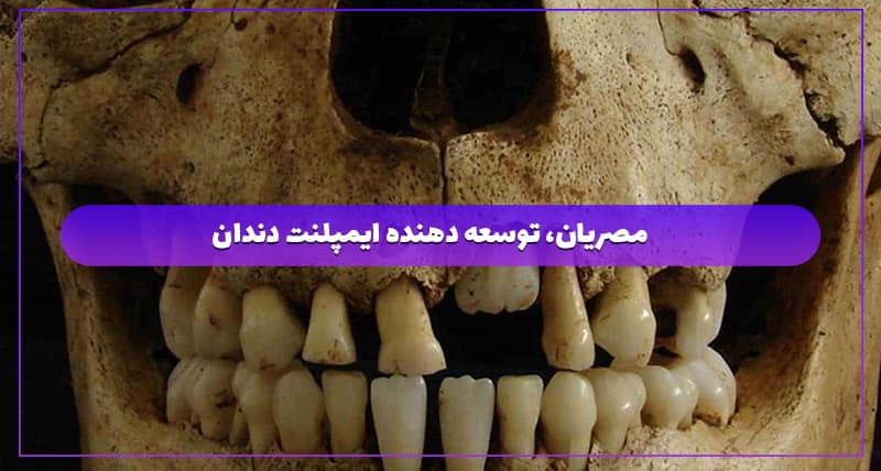 مصریان، توسعه دهنده ایمپلنت دندان