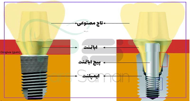Basic structure of a dental implant system