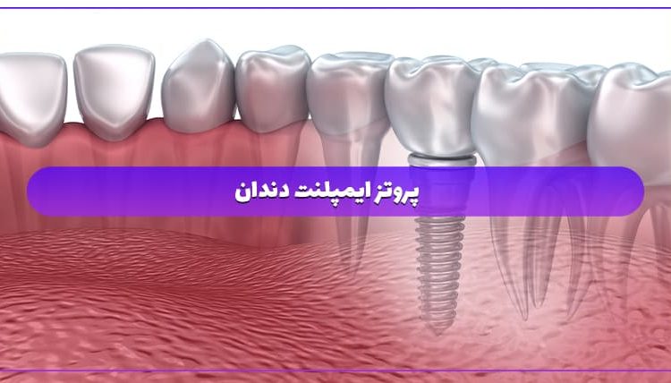 پروتز ایمپلنت دندان