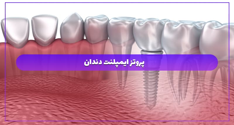 پروتز ایمپلنت دندان