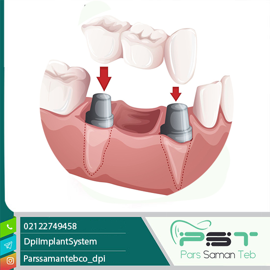 کاهش عوارض بروز ایمپلنت دندان