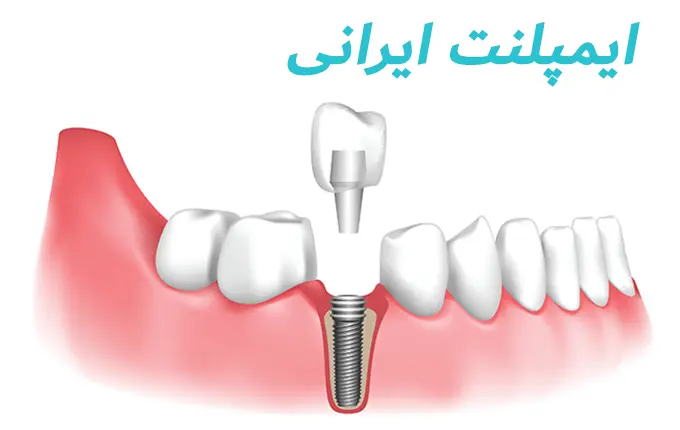 ایمپلنت ایرانی