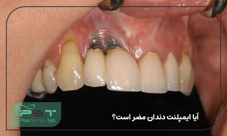 آیا ایمپلنت دندان مضر است؟