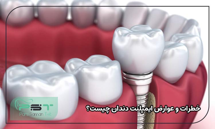 خطرات و عوارض ایمپلنت دندان چیست؟ 
