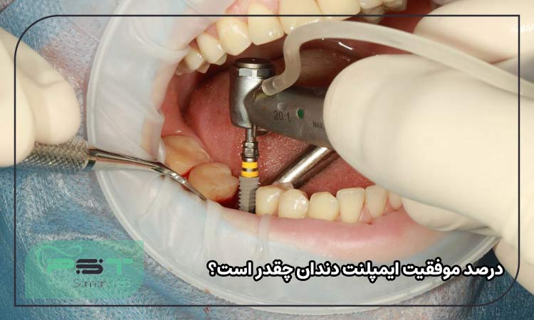درصد موفقیت ایمپلنت دندان چقدر است؟ 