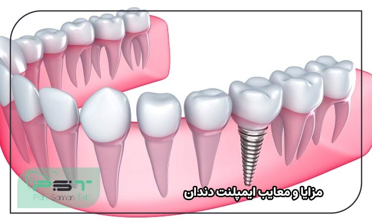مزایا و معایب ایمپلنت دندان