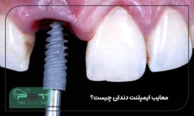 معایب ایمپلنت دندان چیست؟ 