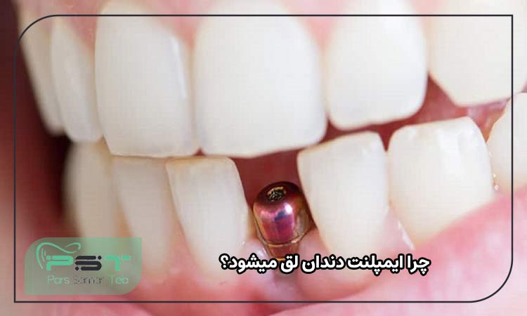 چرا ایمپلنت دندان لق میشود؟