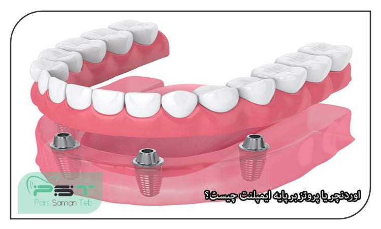 اوردنچر یا پروتز بر پایه ایمپلنت چیست؟