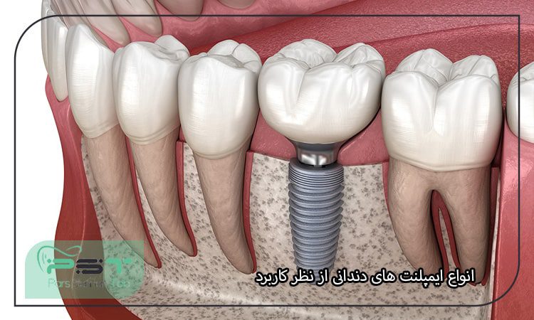 انواع ایمپلنت‌ های دندانی از نظر کاربرد