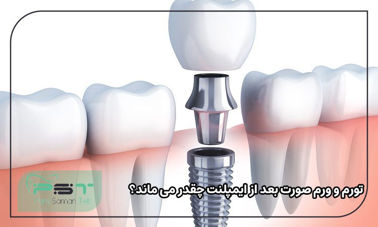 تورم و ورم صورت بعد از ایمپلنت چقدر می ماند؟