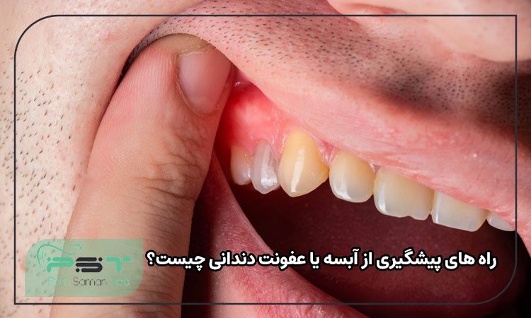 راه های پیشگیری از آبسه یا عفونت دندانی چیست؟