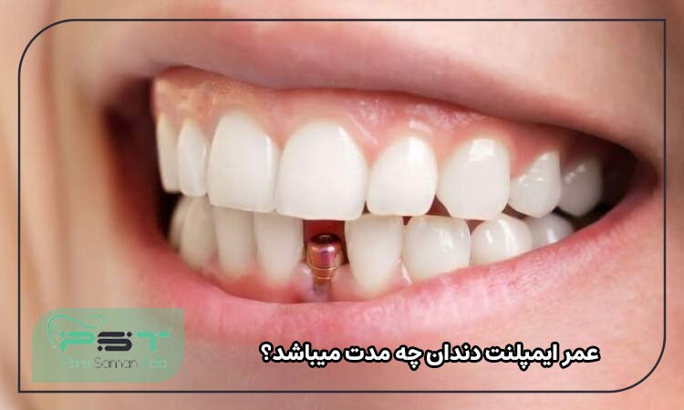 عمر ایمپلنت دندان چه مدت می‌باشد؟
