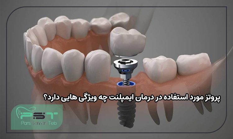 پروتز مورد استفاده در درمان ایمپلنت چه ویژگی هایی دارد؟