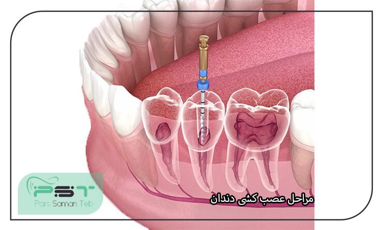 مراحل عصب کشی دندان