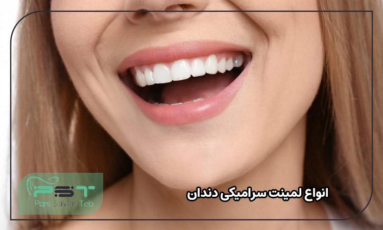 انواع لمینت سرامیکی