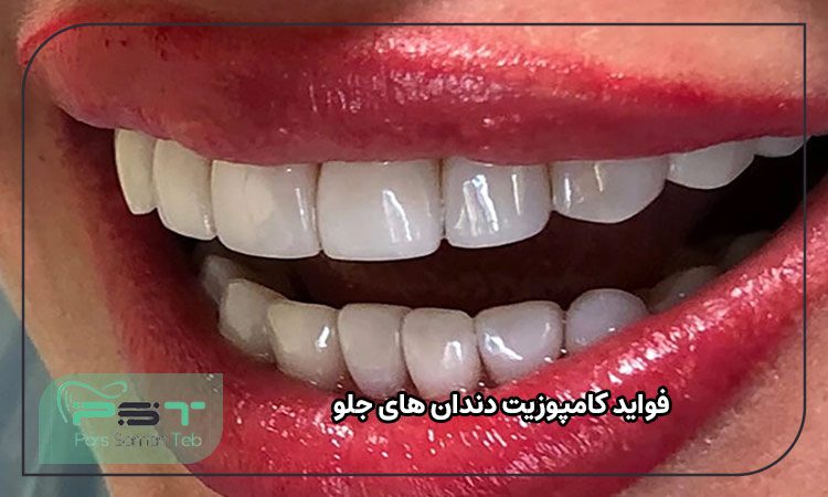 عوارض کامپوزیت دندان های جلو