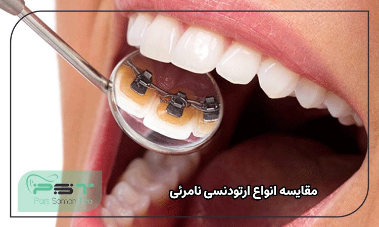 مقایسه انواع ارتودنسی نامرئی