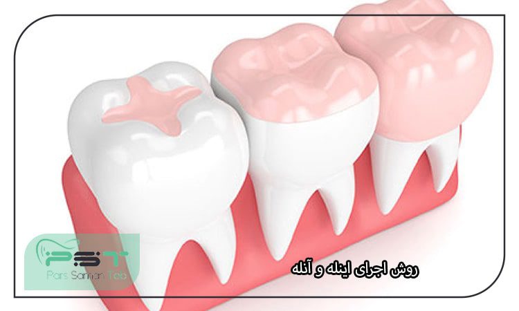 روش اجرای اینله و آنله