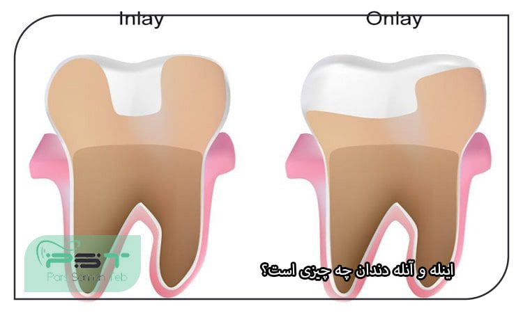 اینله و آنله دندان چه چیزی است؟