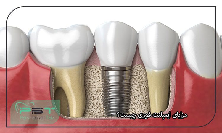 مزایای ایمپلنت فوری چیست؟