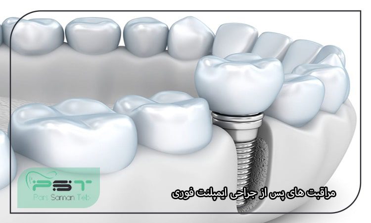 مراقبت های پس از جراحی ایمپلنت فوری