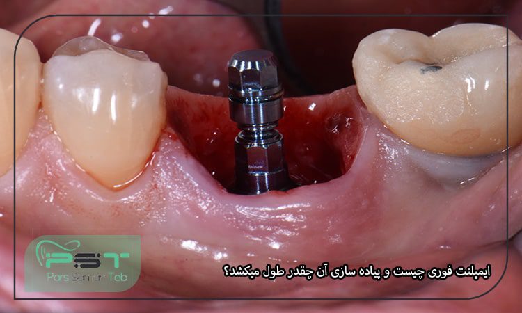 ایمپلنت فوری چیست و پیاده سازی آن چقدر طول میکشد؟