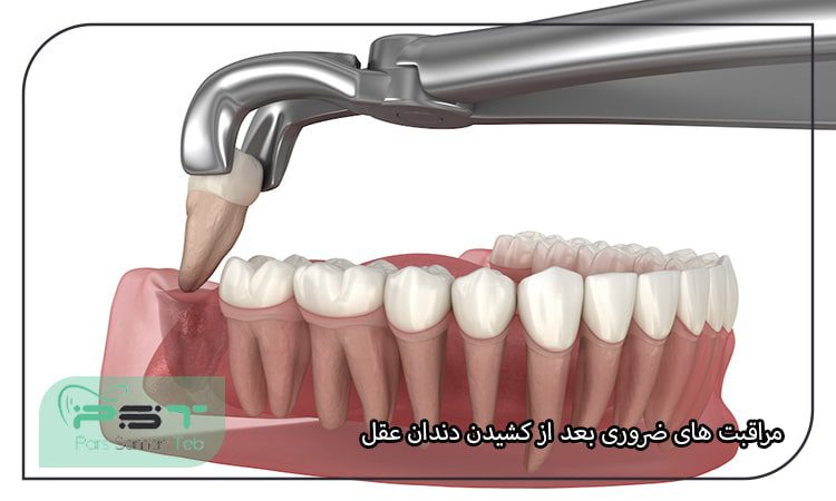 مراقبت های ضروری بعد از کشیدن دندان عقل