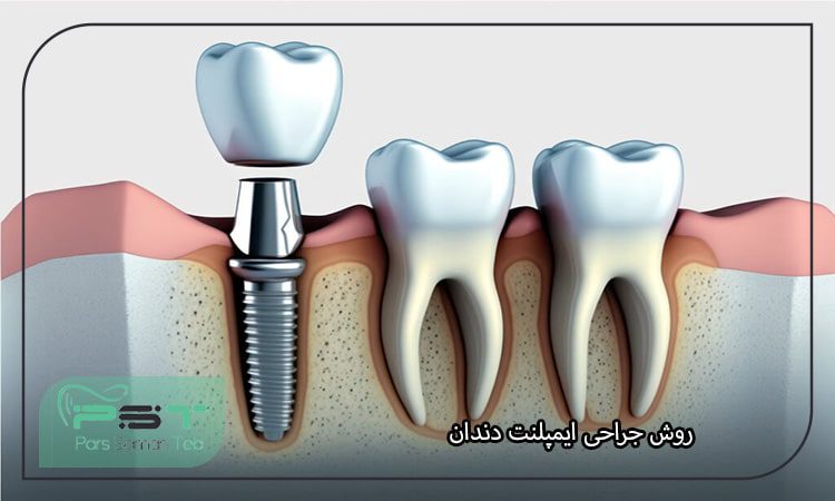 روش جراحی ایمپلنت دندان