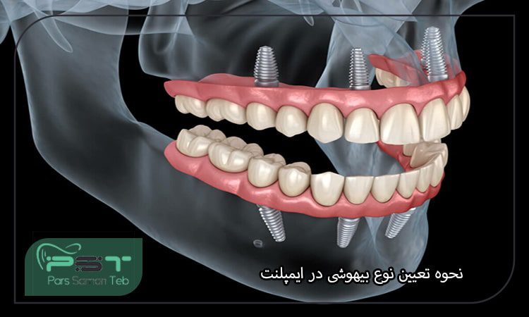 نحوه تعیین نوع بیهوشی در ایمپلنت