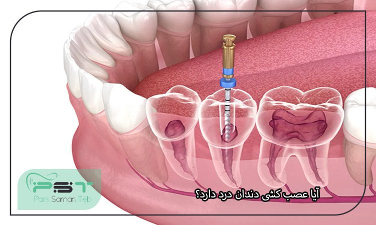 آیا عصب کشی دندان درد دارد؟