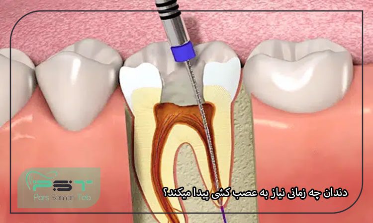 دندان چه زمانی نیاز به عصب کشی پیدا میکند؟