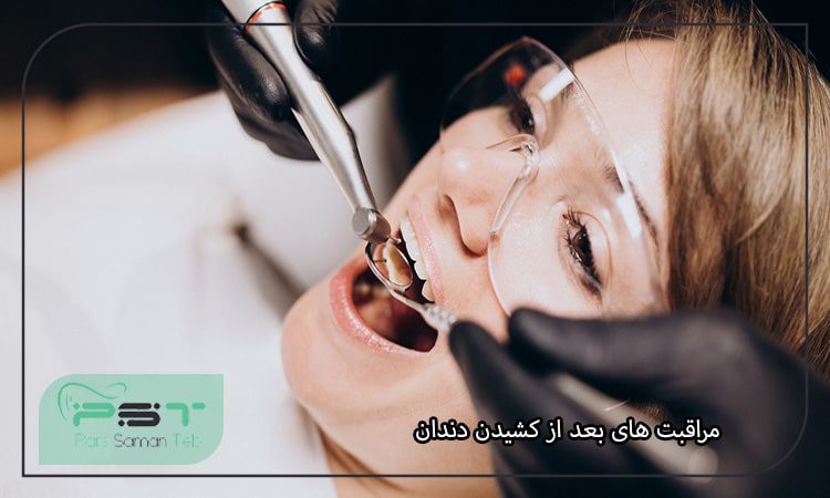 مراقبت های بعد از کشیدن دندان چیست؟