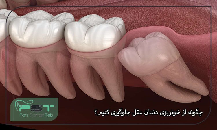 چگونه از خونریزی دندان عقل جلوگیری کنیم؟