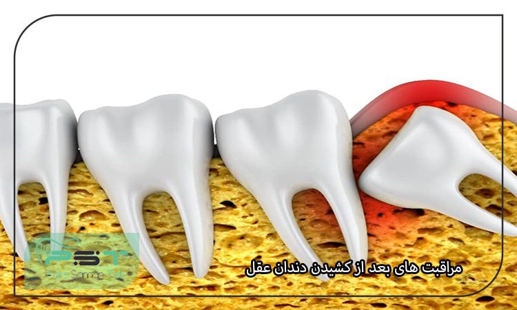 مراقبت های بعد از کشیدن دندان عقل