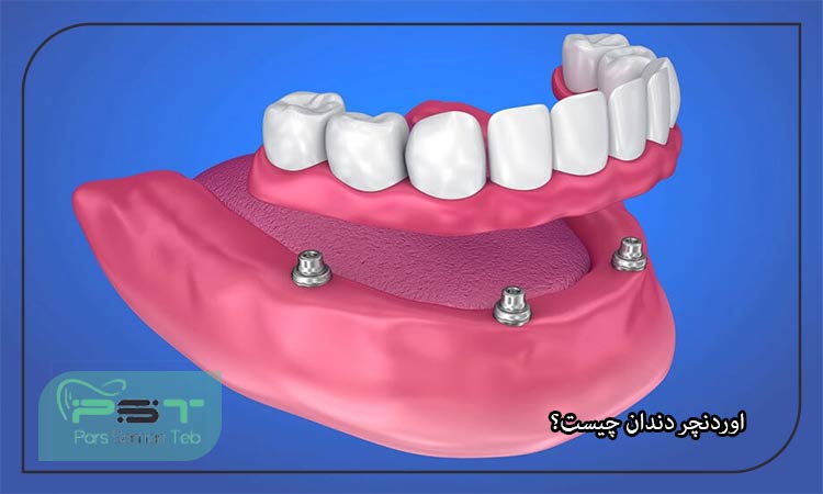 همه چیز در مورد اوردنچر دندان