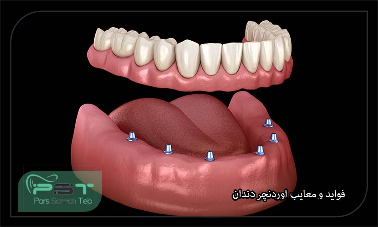 همه چیز در مورد اوردنچر دندان