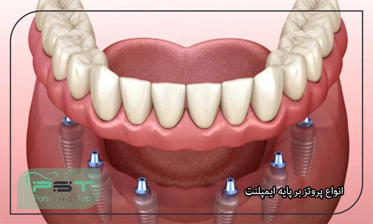 اوردنچر یا پروتز بر پایه ایمپلنت چیست؟