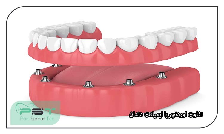 اوردنچر یا پروتز بر پایه ایمپلنت چیست؟