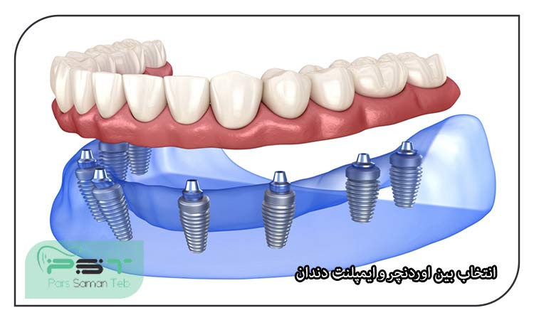 اوردنچر یا پروتز بر پایه ایمپلنت چیست؟