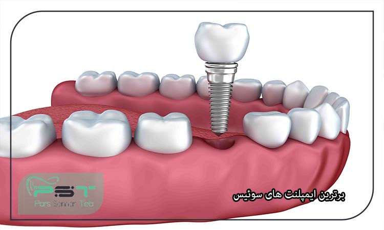 بهترین برند برای ایمپلنت چیست؟
