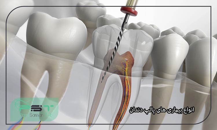 همه چیز راجب پالپ دندان+ روش درمان